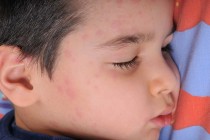 Measles Outbreak Spreads to the Valley